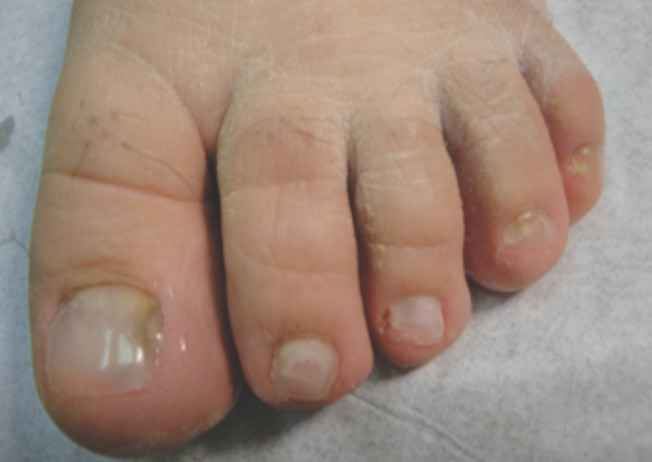 toenail damage after-2