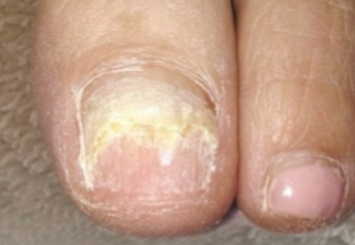 toenail damage before-1