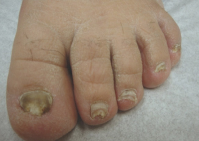 toenail damage before-2